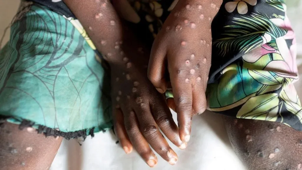 Maymun Çiçeği (Monkeypox) Virüsü Nedir? Belirtileri Nelerdir? Tedavisi Var Mı?